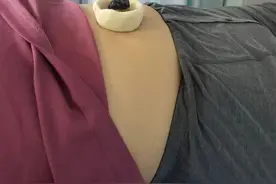 着眼“全能”脐灸图片