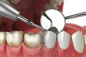 为什么口腔科医生推荐你用牙线、定期洗牙？图片