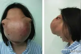 浙江女孩蒙面生活13年，医生掀开盖头吓出一身冷汗：这是人是马？图片