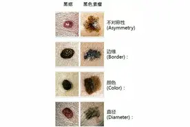 身上这些痣别乱点，可能会致癌图片