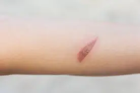 瞬间解决被热水烫伤的小妙招图片