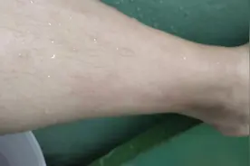 皮肤深度烫伤到恢复全过程图片