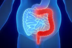 Lancet重磅：14页综述详解溃疡性结肠炎图片