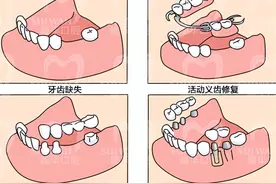 半口、全口缺牙后，是该选择活动假牙还是种植牙？图片