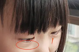 眼睛下面这条“线”，能反映大问题，严重的影响长高和发育！快看看你家娃有没有图片