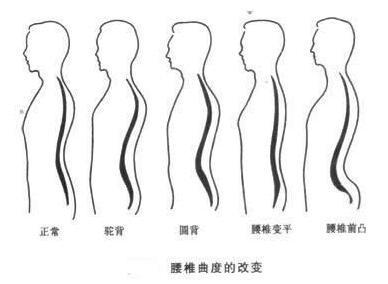 肋骨外翻的原因及纠正性训练