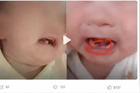 婴儿刚出生就长牙，诞生牙了解一下！图片