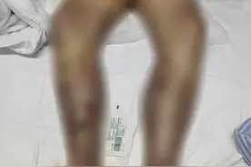 女子玩水后第四天，高烧、长皮疹，医生看到脚上伤口：截肢保命吧图片