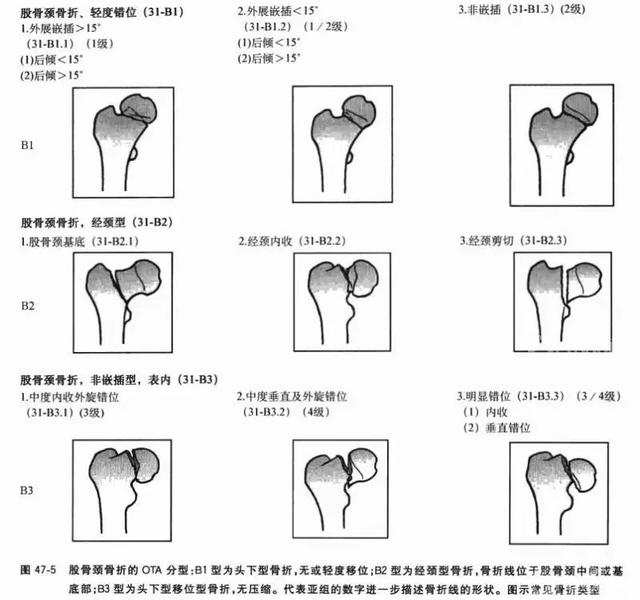一文掌握股骨颈骨折的分型