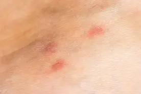皮肤科医生和你聊聊：在温暖潮湿的季节，注意防治丘疹性荨麻疹图片