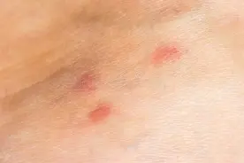 皮肤科医生和你聊聊：在温暖潮湿的季节，注意防治丘疹性荨麻疹图片