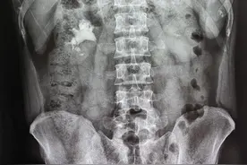 结石都快长满肾脏了，身体却没什么反应！不痛的结石 伤肾于无形图片