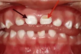 孩子牙齿出现白色斑点，一定要警惕图片