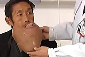 故事：山东40岁男子下巴巨大无比，为了家庭求医，医生：从没见过图片