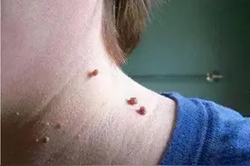 脖子和腋下的“小肉粒”是什么？可以用手直接揪掉吗？别忽视了图片