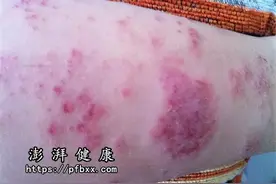 一吃辣的身上就痒起红疹子，手上就长透明小水泡图片