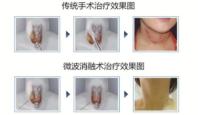 甲状腺超声报告看不懂？那是你方法没找对，一张表帮你读懂良恶性