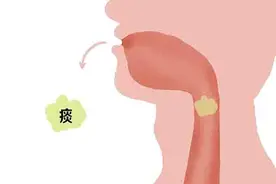 嗓子有痰，痰多吐不完，该怎么办？不同颜色的痰，说明了什么？图片