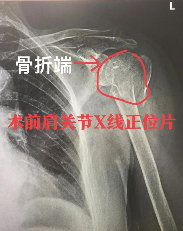 肱骨近端骨折系列之合并大结节撕脱性骨折治疗