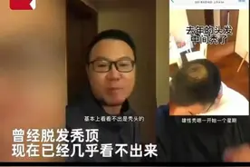 秃顶男子半年不用洗发水变满头黑发，真的是洗发水的锅吗？图片
