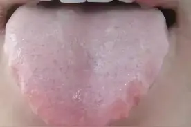 齿痕舌，不全是脾虚？还有这四种症状，四种中成药帮你调图片