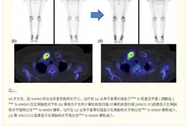 定量骨 SPECT/CT 评估胸锁关节炎患者的治疗反应图片