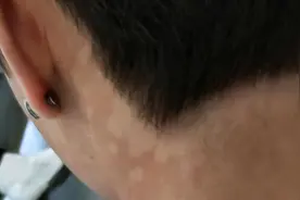 一到夏季，后背长了一些褐色的斑点，这是什么皮肤病？图片
