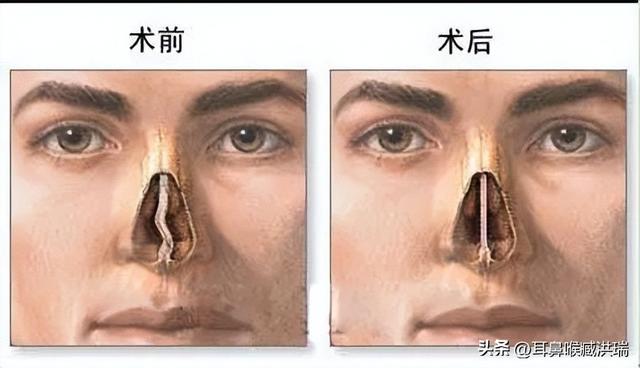 鼻中隔大讲堂：有鼻中隔偏曲25年了，北京手术费用一共多少钱？
