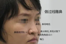 29岁“小阿姨”嘴凸、法令纹深！膨体鼻修复8mm改变，换了张脸？图片