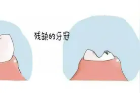 医生，我嘴巴只剩几个残根了，必须要拔掉吗？图片