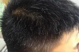 白头发的原因找到了，少白头、中白头、老白头的治法在此图片