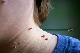 脖子和腋下的“小肉粒”是什么？能用手抠掉吗？别忽视了图片