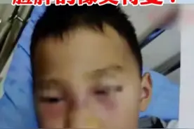 挖鼻孔导致脸肿似奥特曼，到底是怎么回事？作为家长你焦虑了吗？图片