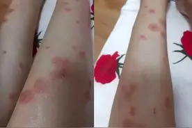 去公园小心！这飞虫比蚊子毒，一咬痒几天，有人花2千块没治好要看急诊图片