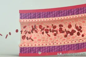 血小板增多症会转化为白血病吗？如何降低血小板增多转白机率？图片