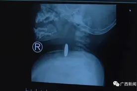 婴儿误吞异物致进食困难、持续发热！异物卡喉怎样做？图片