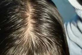 试了二十多款防脱育发洗发水后，两款洗发水，两月碎发炸满头！图片