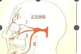 走近神经痛之三叉神经痛图片