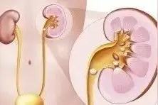肾结石疼痛无需再忍！4个方法止痛+5种方式排石图片