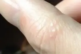 手上长透明小水泡，是上火吗？或许很多人想错了，可能是它在作怪图片