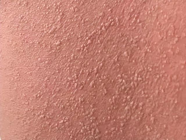 通过详细询问病史,用药史,既往过敏史,这名孩子最终也诊断为"急性泛发