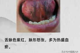 舌下血管又黑又粗，多是瘀血作怪，一个中成药搭配 ，化尽一身瘀血图片