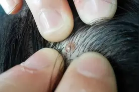 头皮里，老是长疙瘩和脓包，是怎么了？提醒：或是3种疾病预警图片