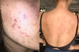 后背成螨虫窝长满小疙瘩？过来人教你三个小妙招，在家除螨祛痘！图片