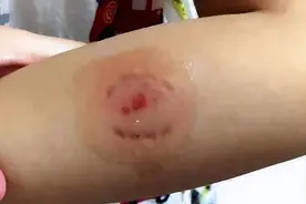 一针破伤风1岁娃躺进急救室！孩子磕破头、被人咬到底该不该打针图片