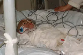 2011年毒父反复用开水浇女儿，社会捐款200万后，母亲争抢抚养权图片