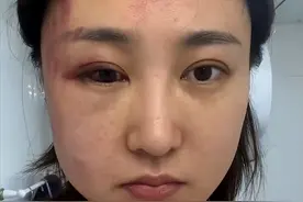 34岁女星遭家暴后现身派出所！打到眼出血被鉴定轻伤，老公已拘留图片