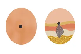 痣只会影响美观？当出现这些变化的时候要注意，可能会危害健康图片