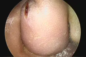 耳朵感染肿胀，吃药没效果，该怎么办图片