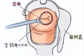 宫颈锥切术——宫颈冷刀锥切(CKC)与宫颈电环切术（LEEP）的区别图片